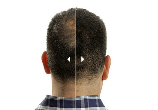 How Effective is Hair Loss Concealer?